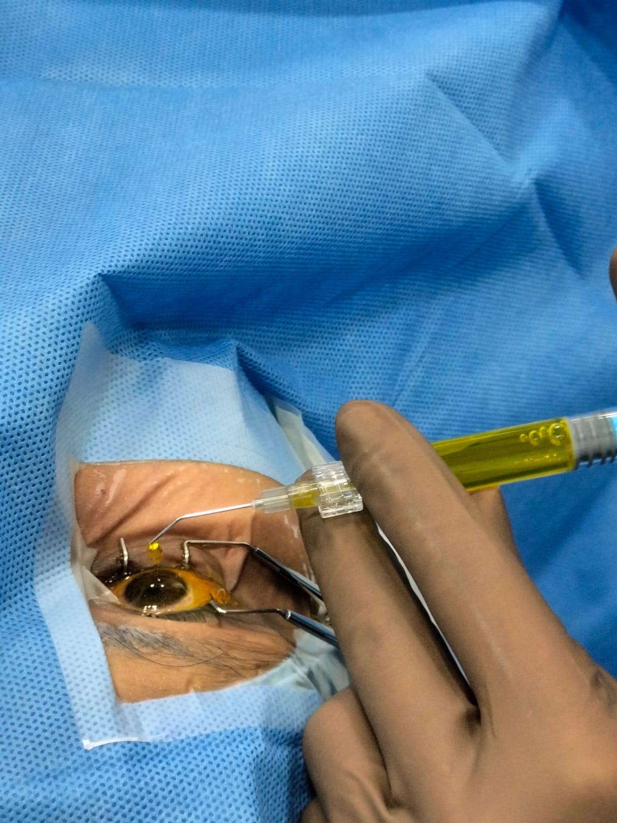 c3r or cxl operation theater with eye specialist and patient