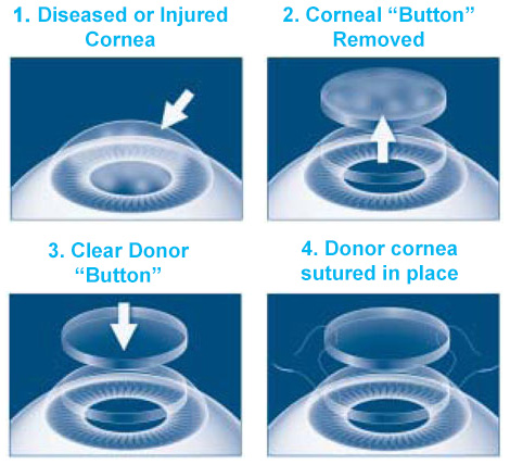 Cornea Image