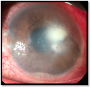 vision before cataract