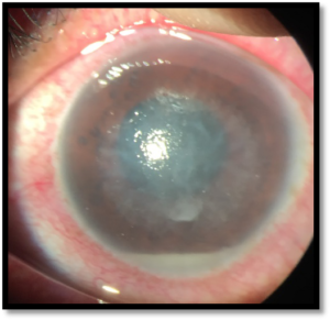 vision after cataract