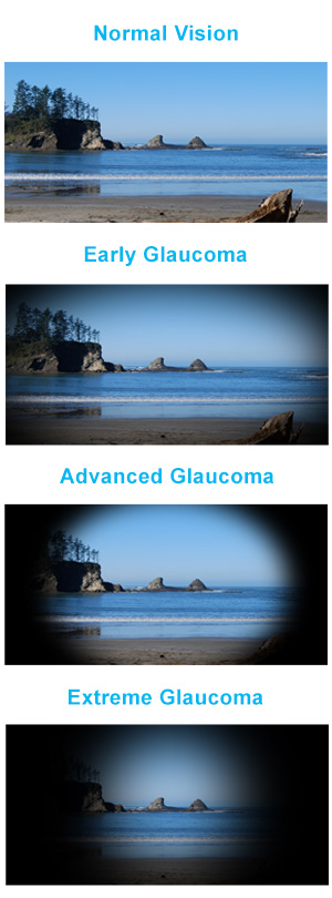 Cornea Image