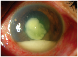 vision before cataract