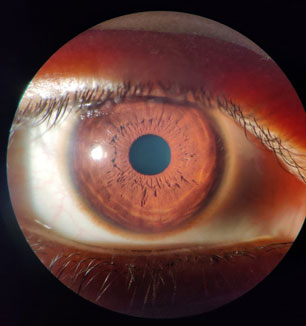 Cornea Image