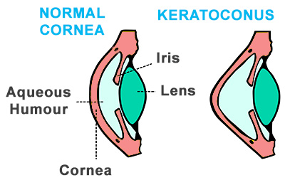 keratoconus-treatment