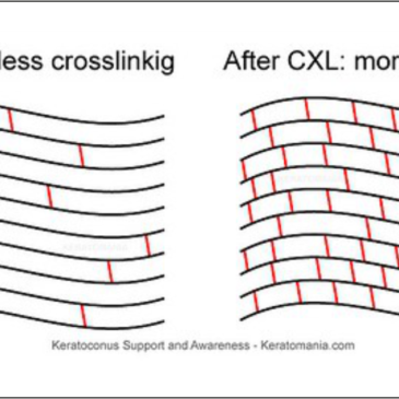 CORNEAL CROSS LINKING (C3R/CXL)
