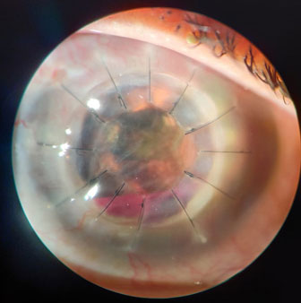 Corneal-full-thickness-Transplant-done-for-a-fungal-corneal-infection
