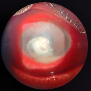 Corneal-infections-Red-congested-eye-with-yellowish-lesion-on-the-cornea-which-is-the-infection