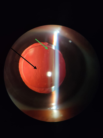 Toric-Multifocal-Intraocular-lens-implanted-in-the-eye-during-cataract-surgery