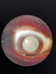 Total cataract