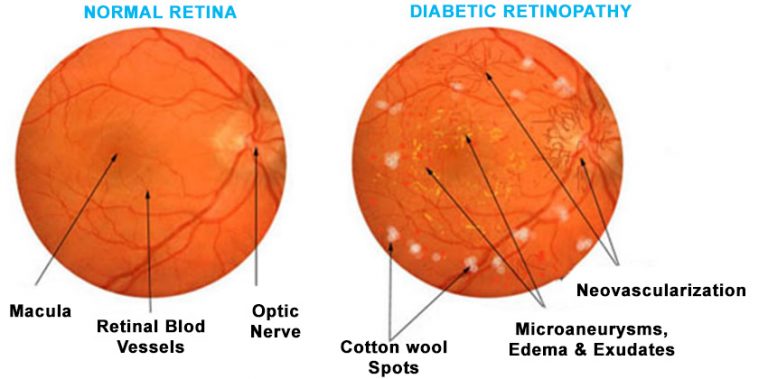 Retina Test, Fundus Checkup, Dilated test, Diabetes in retina