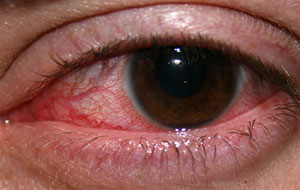 infected-eye