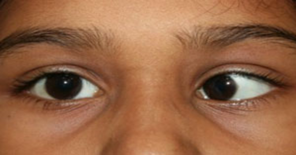 Squint Eye Treatment In Mumbai Squint Correction 99 Cure From Lazy 