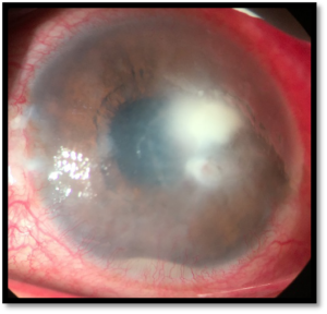 What is Corneal Ulcer?