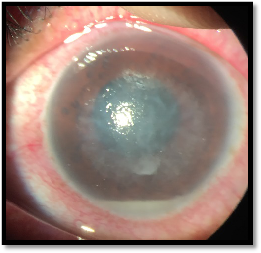 corneal-ulcer1