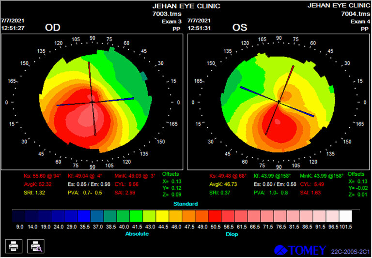 Corneal Topography Test | Topography Eye Test | Jehan Eye Clinic,Mumbai