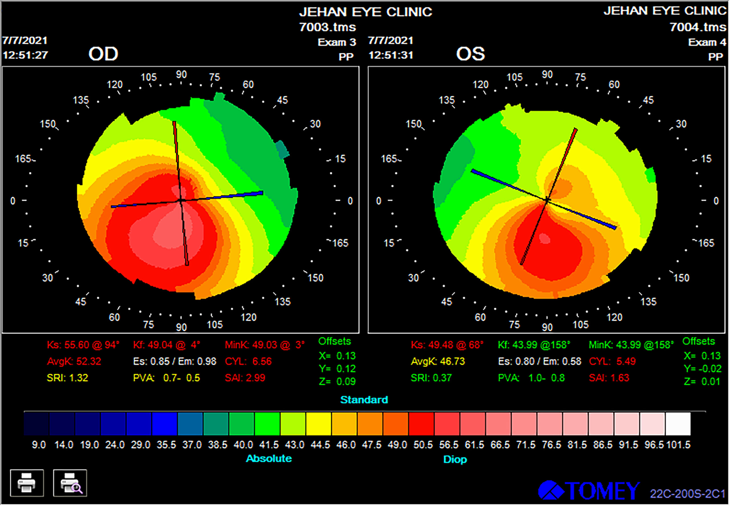 Topography Of Eye