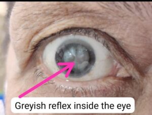 Greyish reflex inside the eye