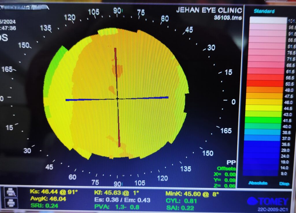 TOPOGRAPHY SCAN